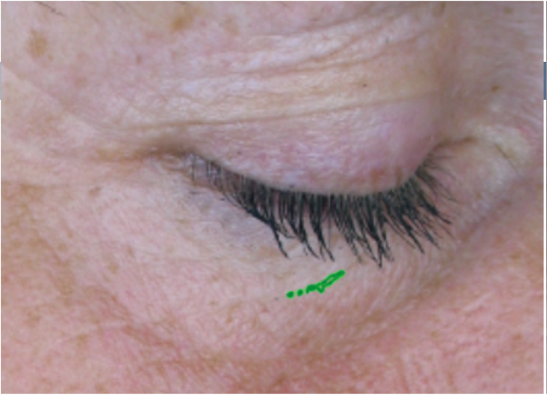 decreased-wrinkles-in-12-weeks-by-34-after decreased-wrinkles-in-12-weeks-by-34-after