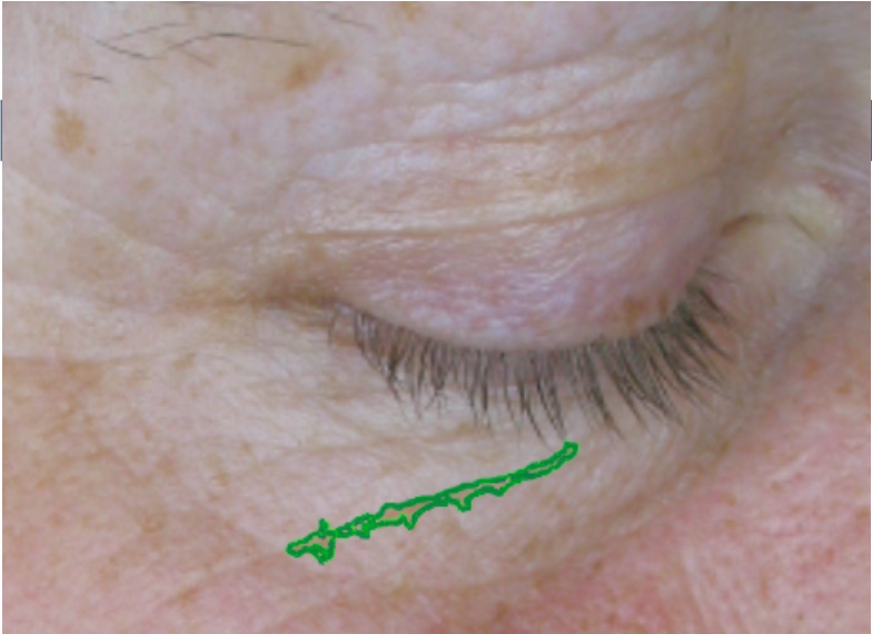 decreased-wrinkles-in-12-weeks-by-34 decreased-wrinkles-in-12-weeks-by-34