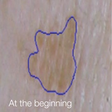 reduced-and-lightened-hyperpigmentation-1