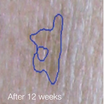 reduced-and-lightened-hyperpigmentation-after